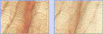Before (left) and after (right) a 30-day application with 0.5% argireline.