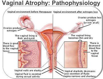Vaginal Atrophy Pathophysiology