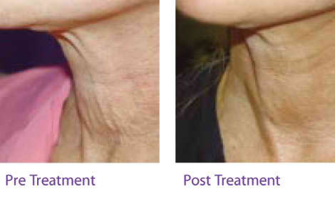 before after skin sagging treatment