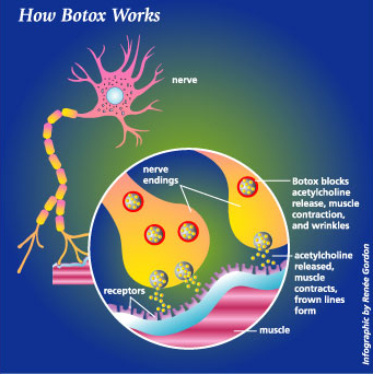 How botox works