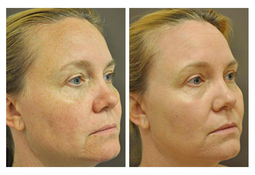 before and after co2 fractional laser