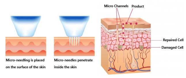 Example of how microneedling device works on the skin.